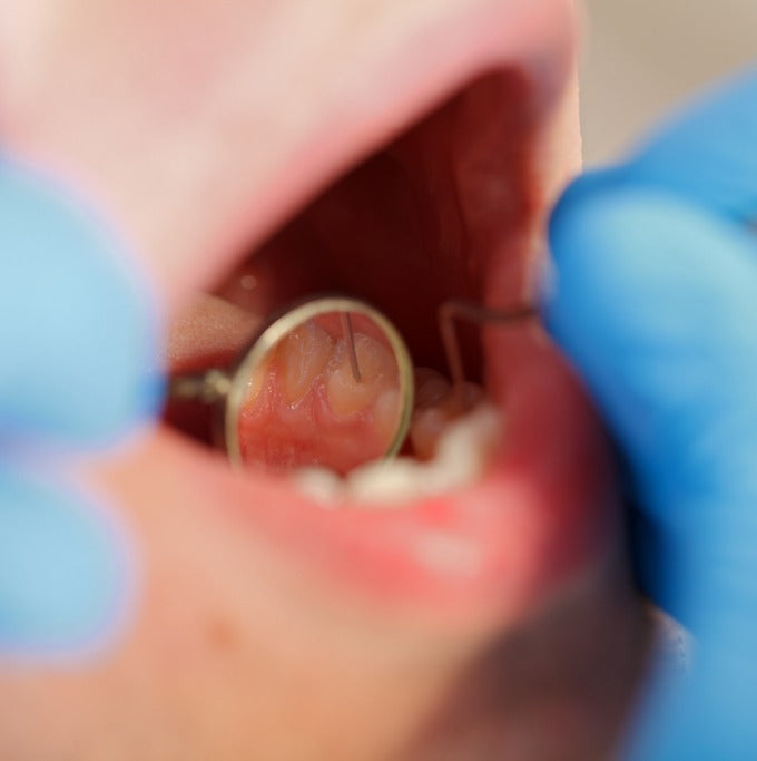 overjet vs overbite