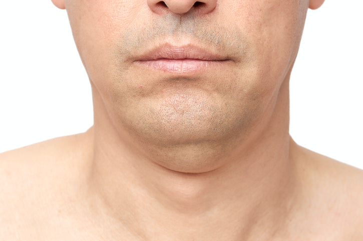 weak chin